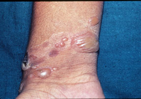 Pemphigus vulgaris wrist