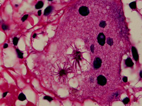 asteroid sarcoidosis